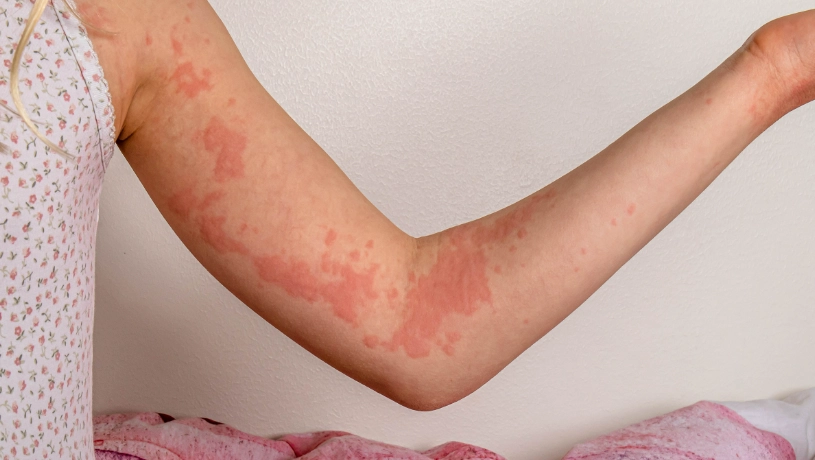 textile dermatitis